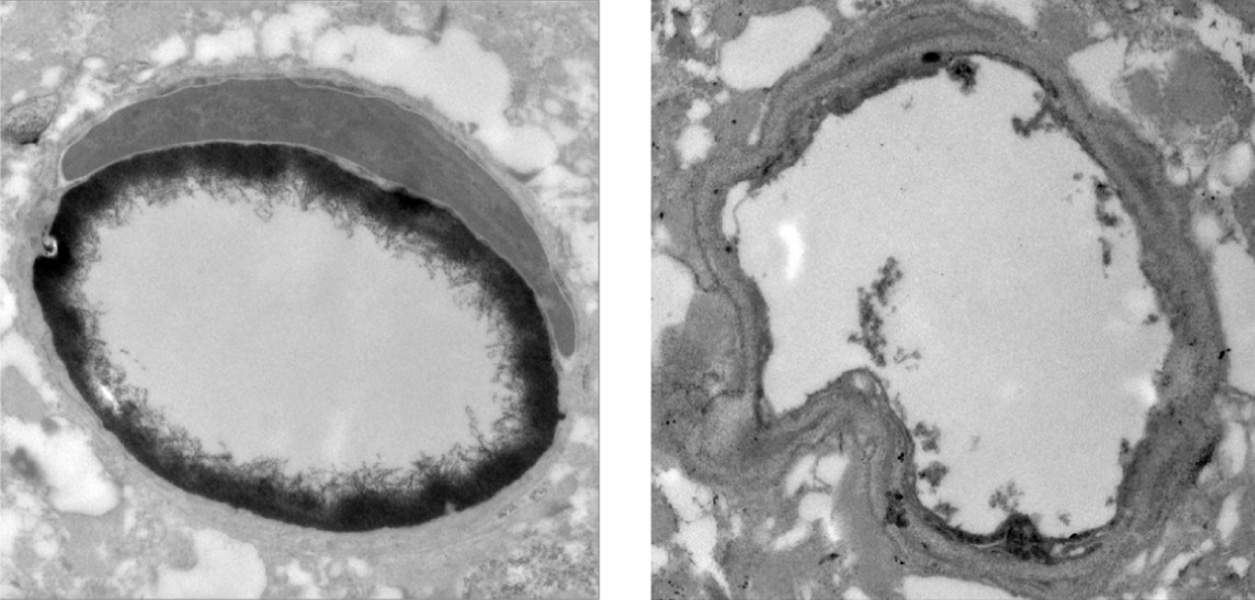Electron microscope images show two images of circular capillaries, side by side. The inner lining of the capillary on the left is thicker.