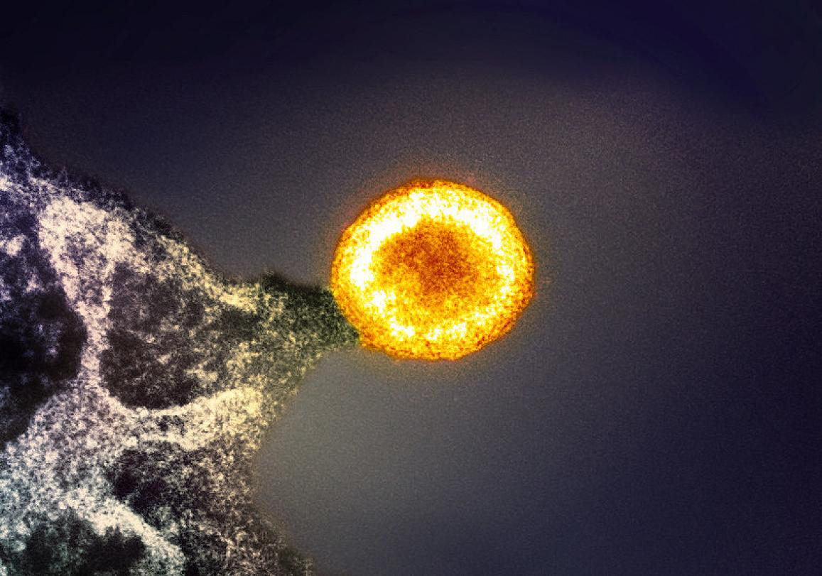 A bright yellow-orange HIV particle is released from a T-cell.
