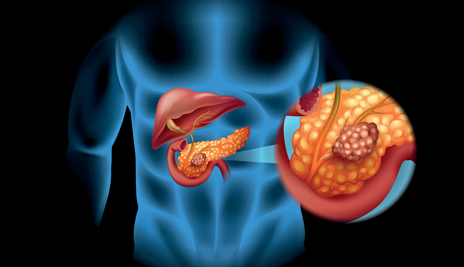 A diagram shows a pancreas with a tumor within the larger digestive system.