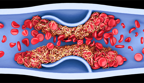An illustration shows a blood clot inside a vein.